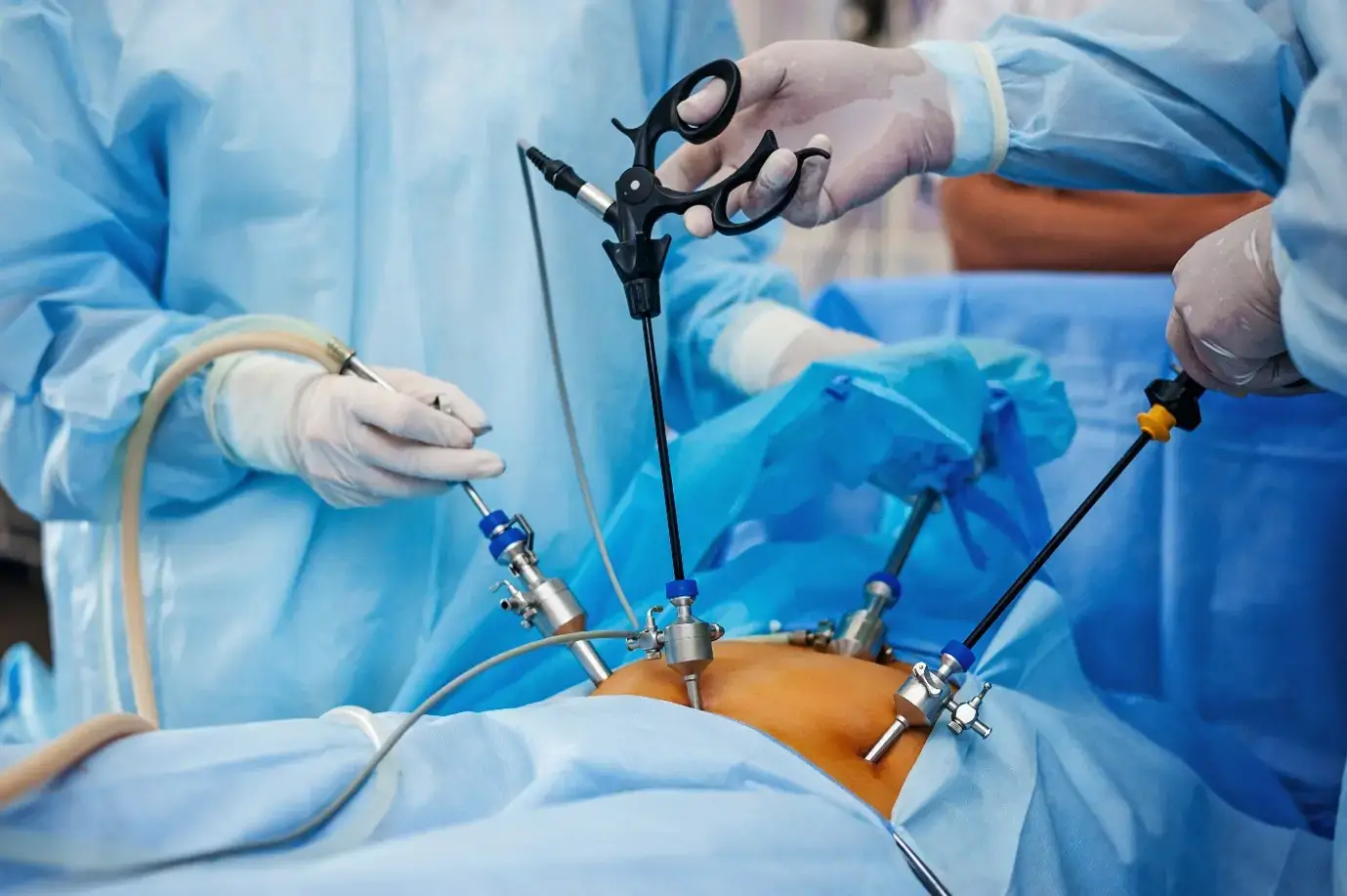 Minimally invasive gynecological laparoscopic surgery procedure in Bhopal