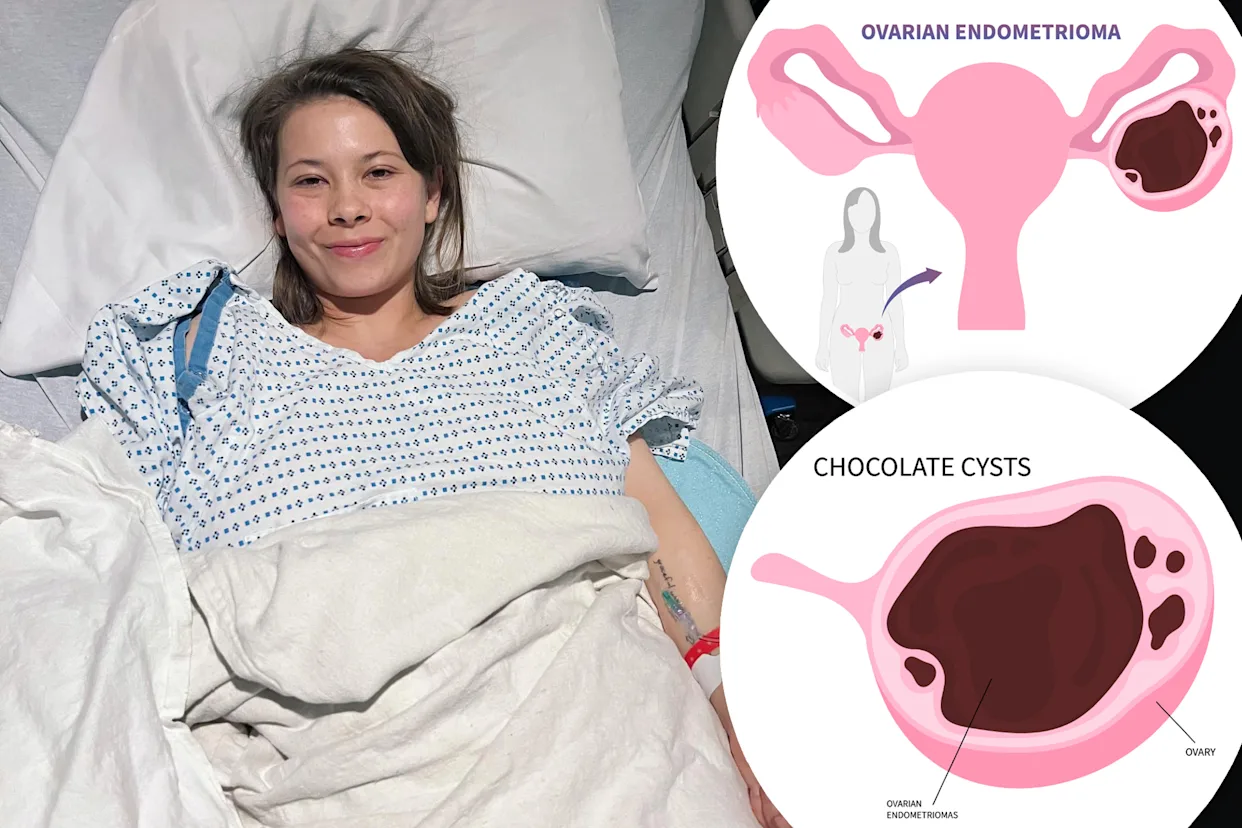 chocolate cyst treatment patient recovery with ovarian endometrioma illustration