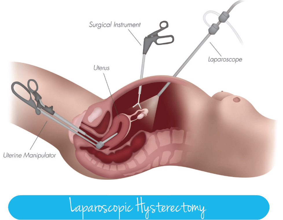 laparoscopic hysterectomy procedure uterus surgery illustration
