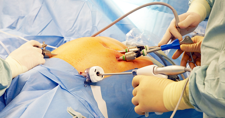 laparoscopic gynecological surgery procedure using instruments in operation theatre