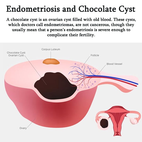 endometriosis and chocolate cyst ovarian cyst filled with blood diagram
