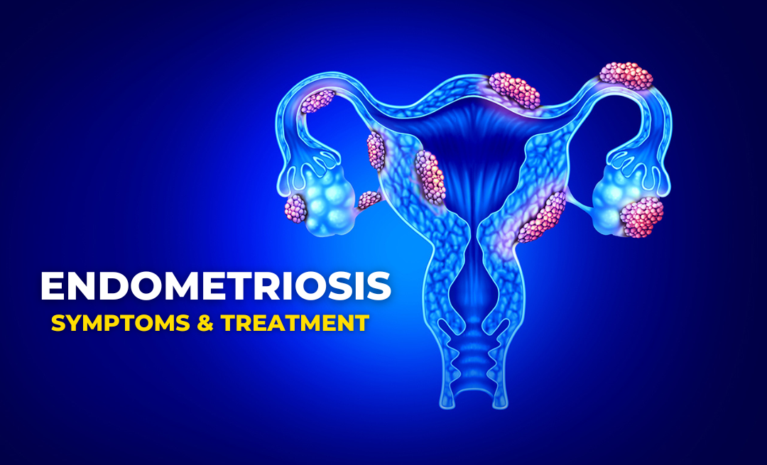 endometriosis symptoms and treatment uterus illustration