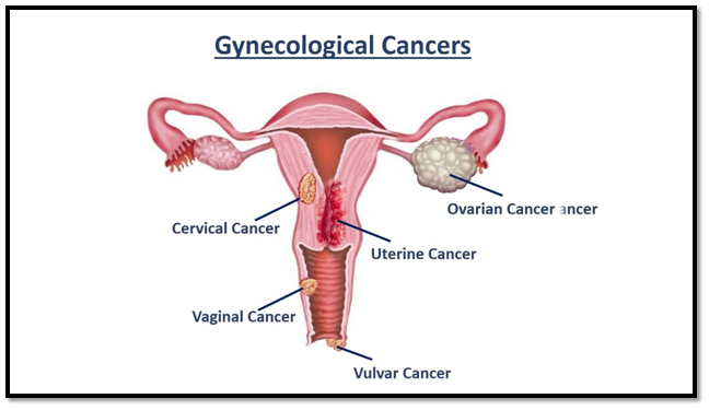 types of gynecological cancers including cervical ovarian uterine vaginal and vulvar cancer diagram