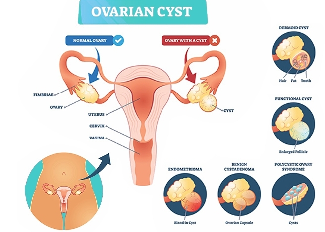 ovarian cyst diagram showing normal ovary and different types of ovarian cysts
