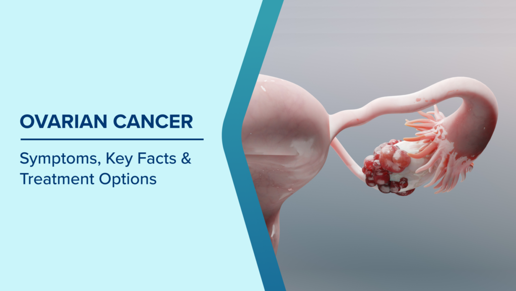 ovarian cancer illustration showing tumor in ovary with reproductive system