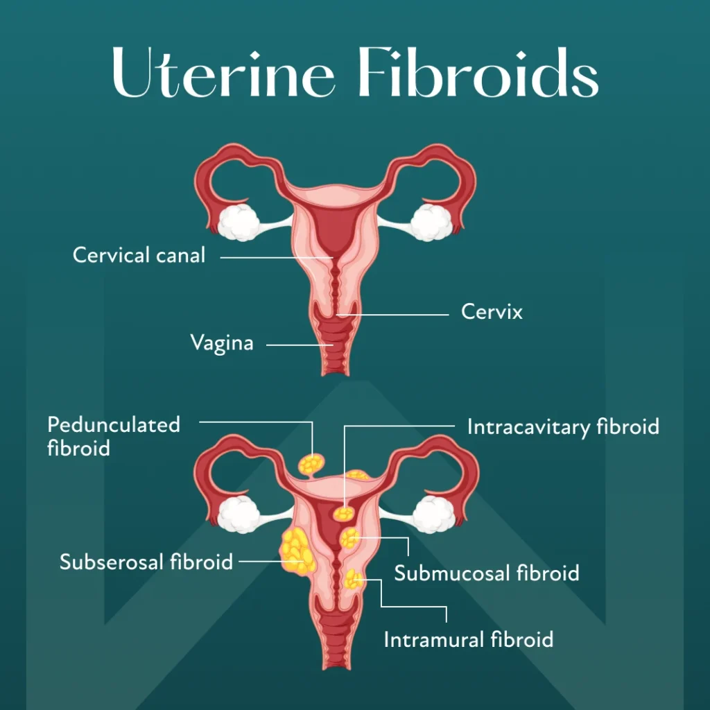 uterine fibroids types including submucosal intramural and subserosal fibroids diagram