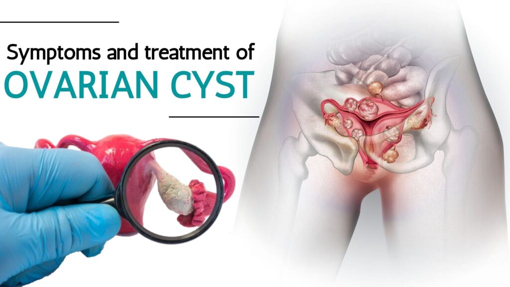 ovarian cyst symptoms and treatment illustration showing cyst in ovary