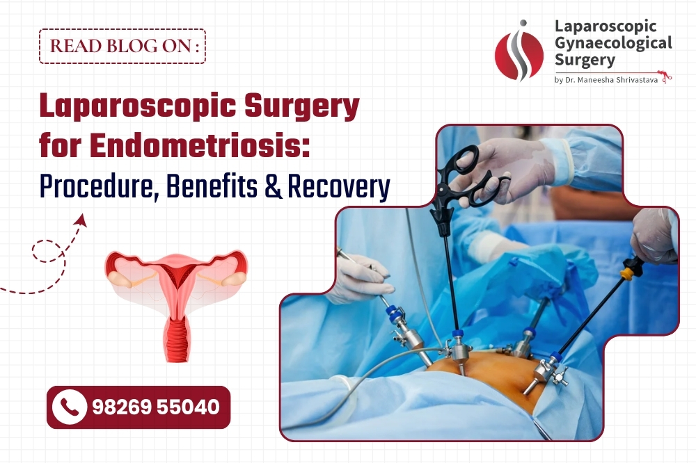 Laparoscopic surgery for endometriosis procedure and benefits in Bhopal