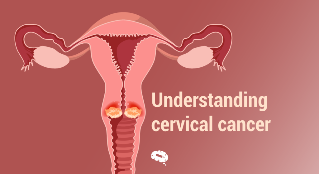 illustration of cervix showing cervical cancer in female reproductive system