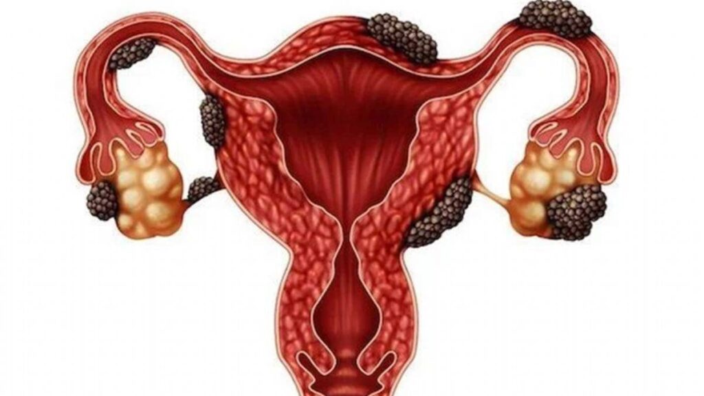 chocolate cyst in ovary endometriosis cyst affecting uterus and ovaries illustration