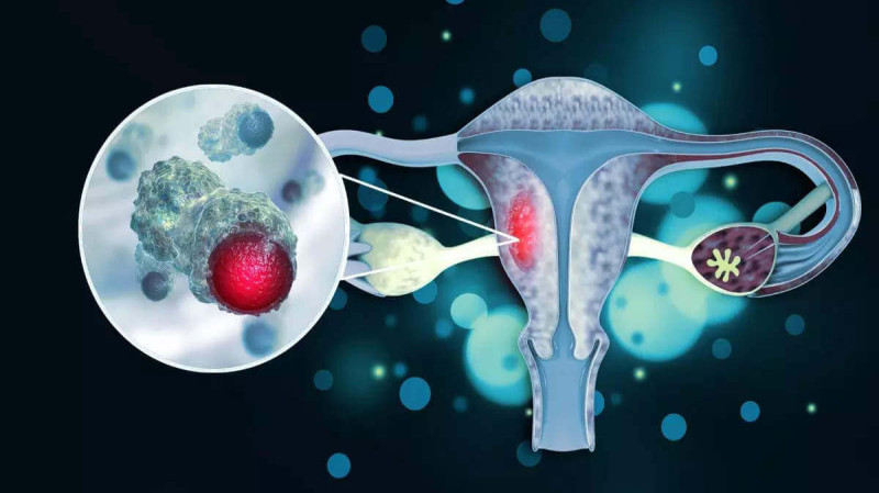 gynecological cancer affecting uterus illustration with tumor visualization