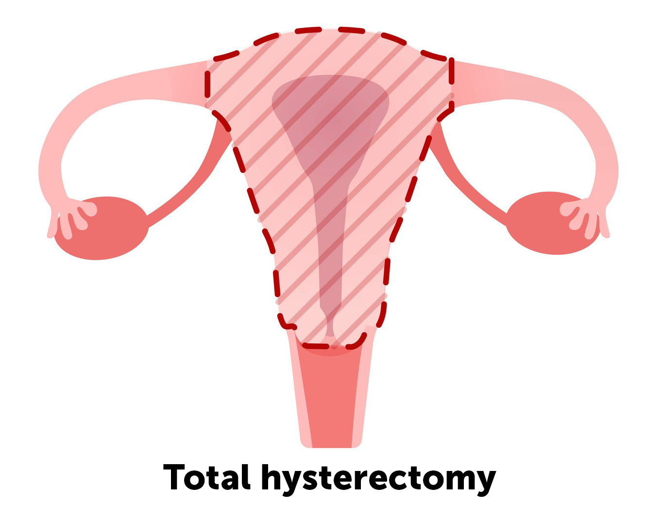 total hysterectomy uterus removal diagram
