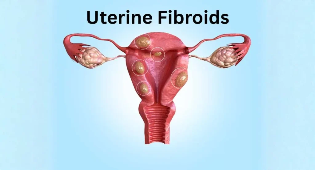 uterine fibroids multiple growths in uterus fibroid uterus treatment diagram