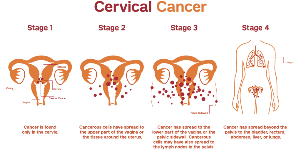 Stages of cervical cancer from stage 1 to stage 4 diagram