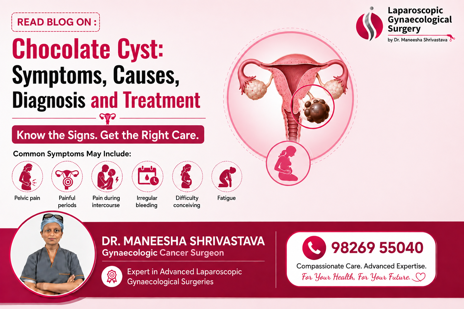Chocolate cyst infographic showing symptoms including pelvic pain, painful periods, pain during intercourse, irregular bleeding, difficulty conceiving, and fatigue, with an illustration of an ovarian chocolate cyst.